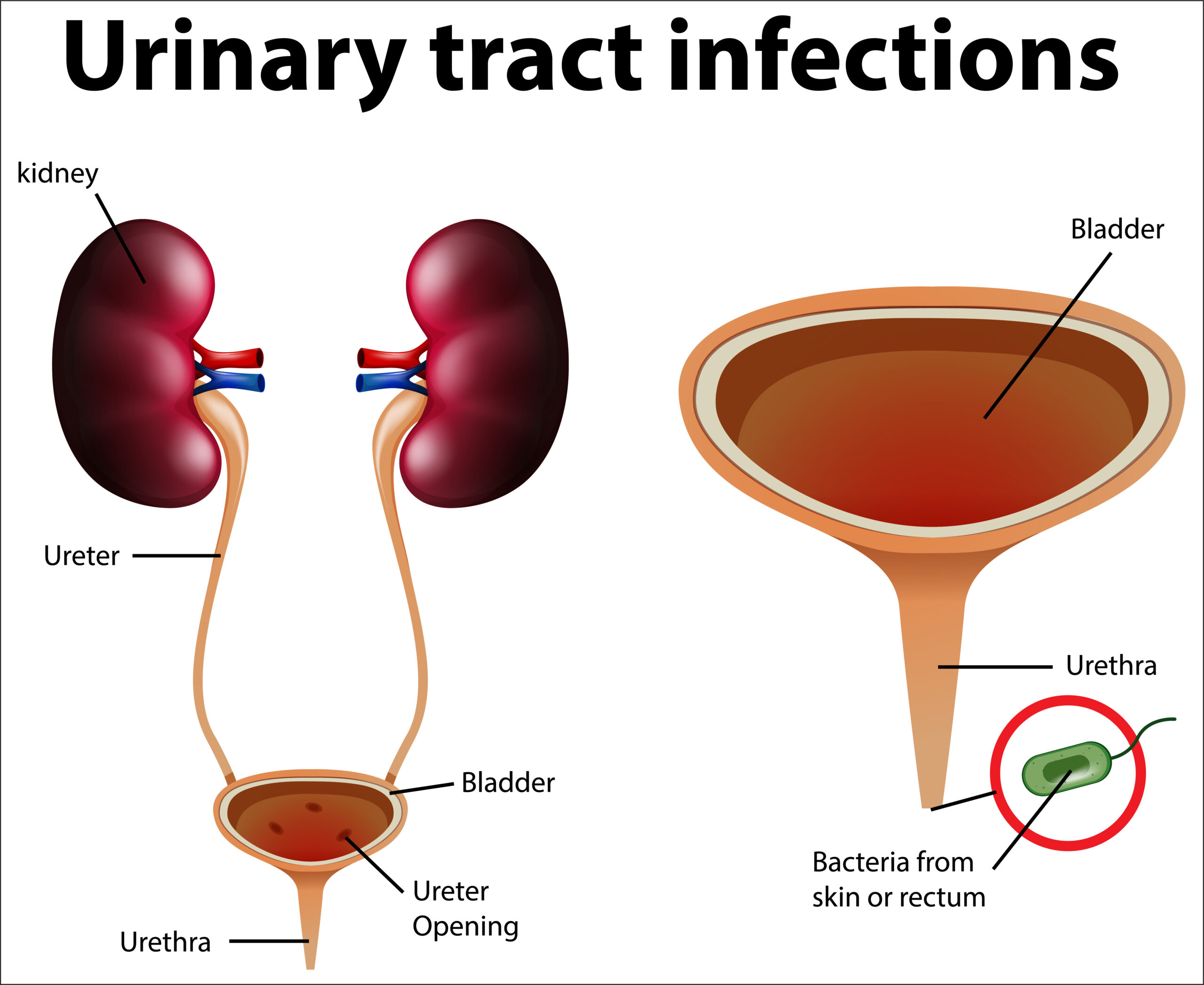 urinary-tract-infection-causes-symptoms-and-treatment-november-2023